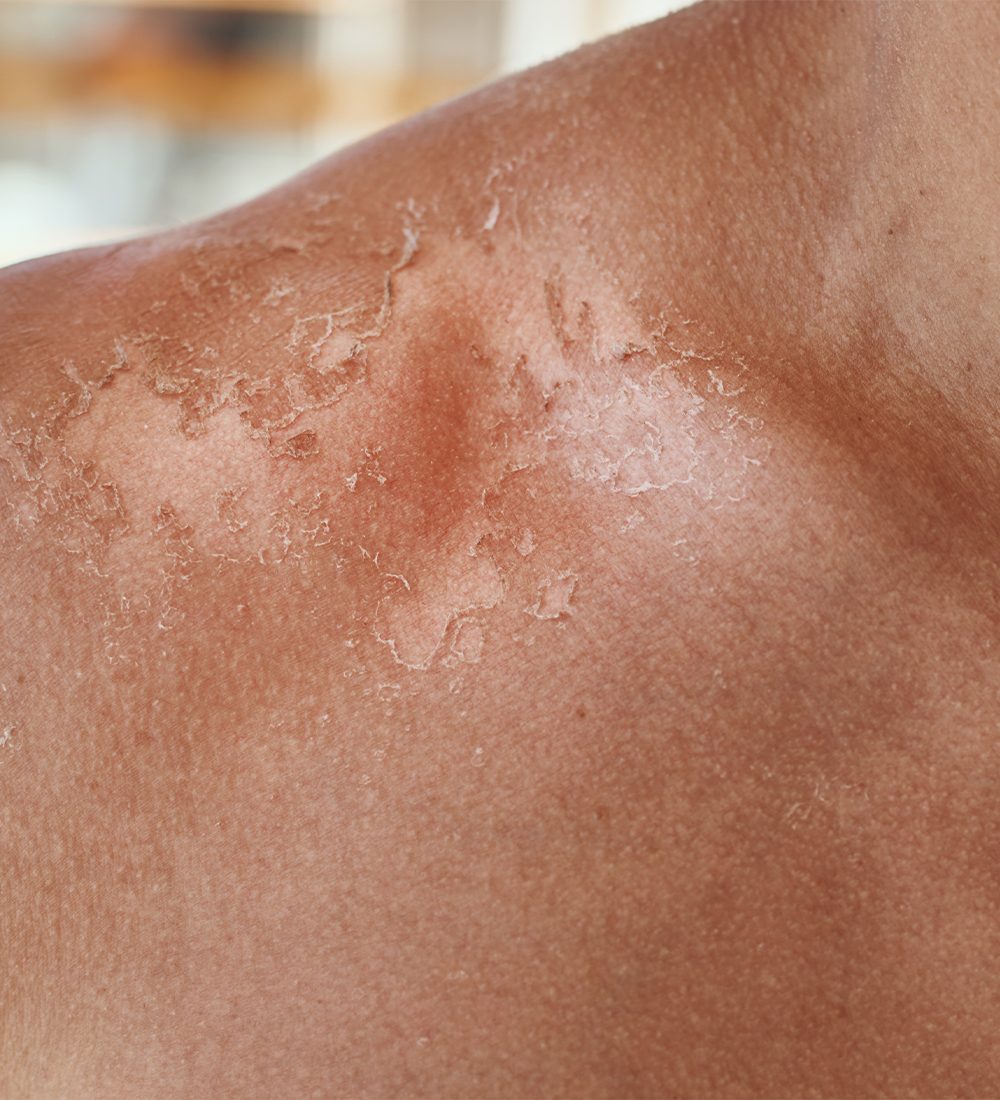 Acanthosis Nigricans Treatment c