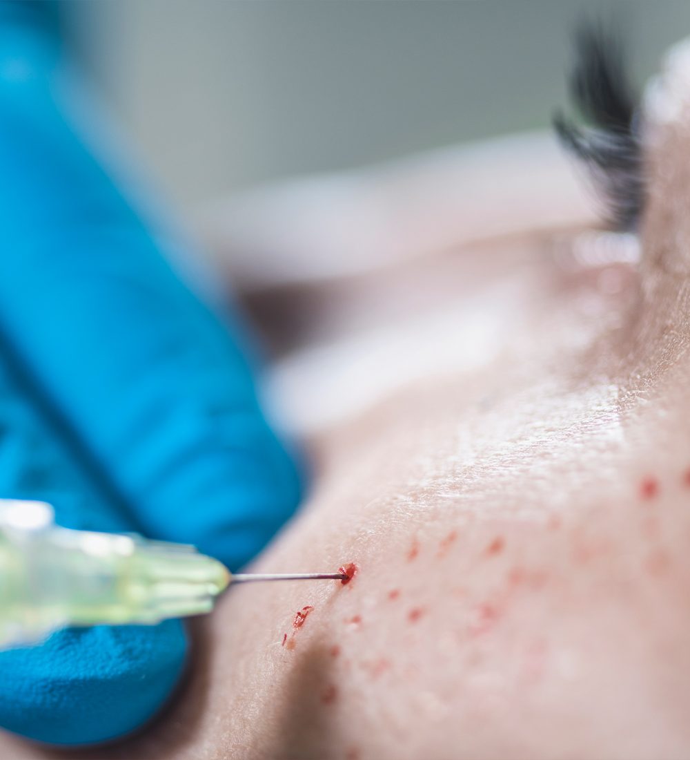 Acne Scar Removal c