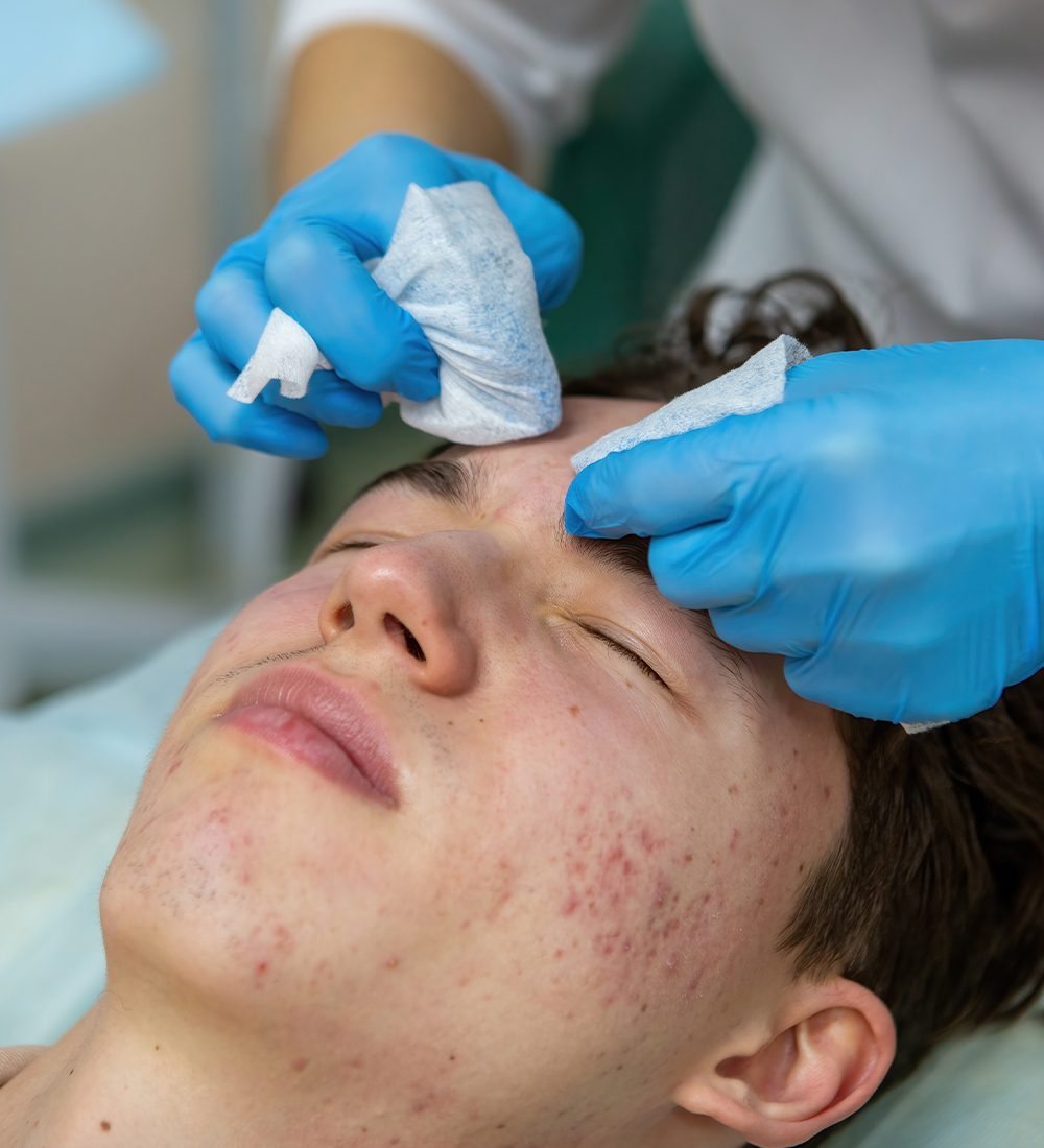 Acne Treatment c