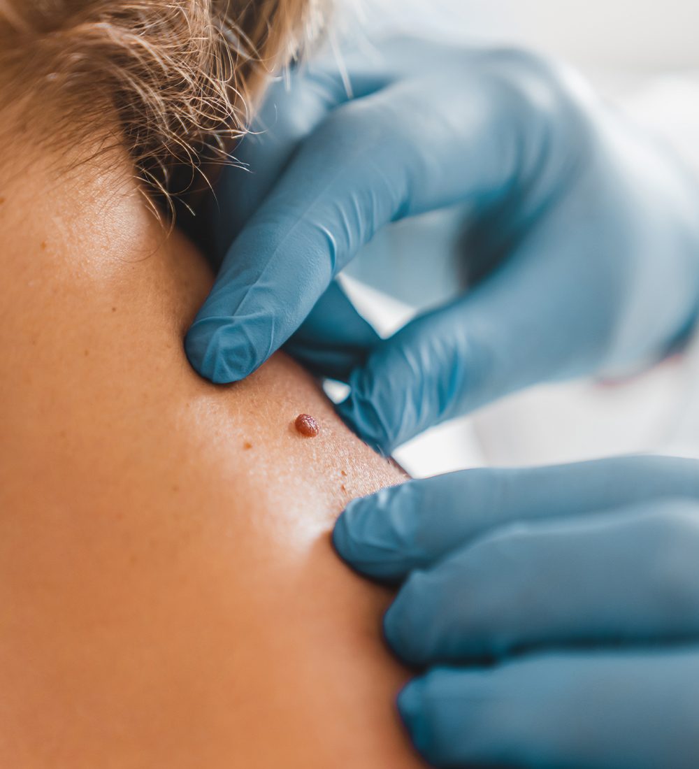 Keloid Removal c