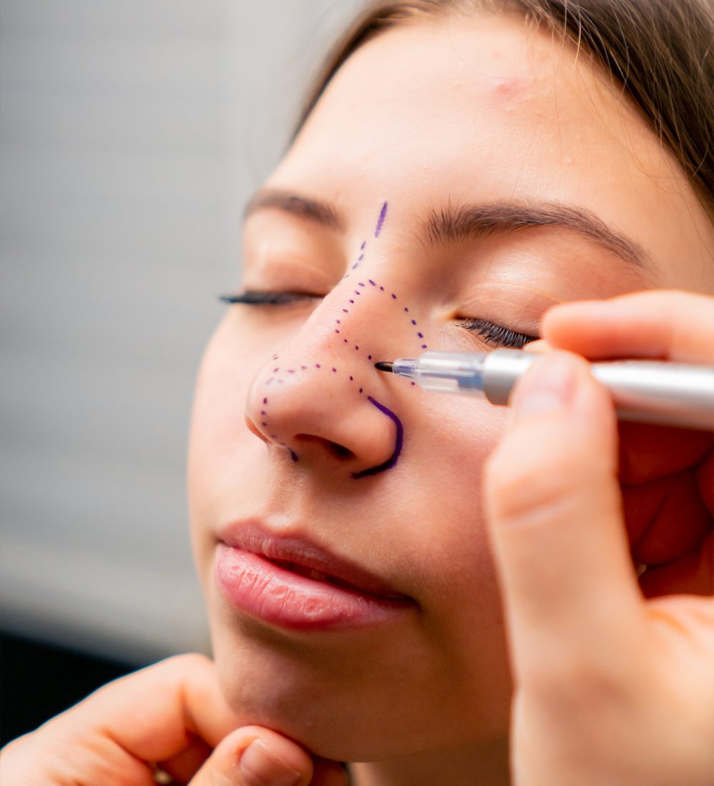 Rhinoplasty C