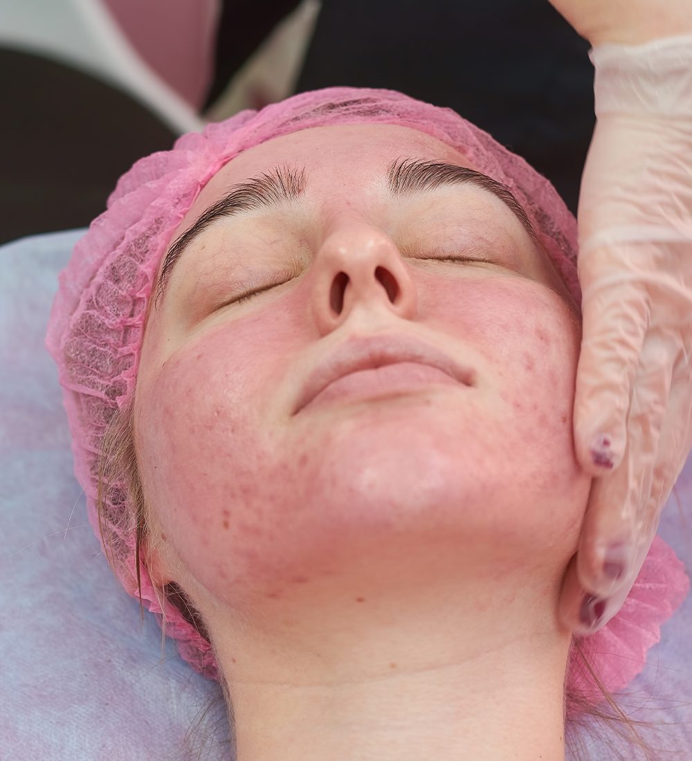acne rosacea c