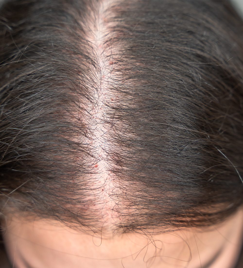 alopecia areata c