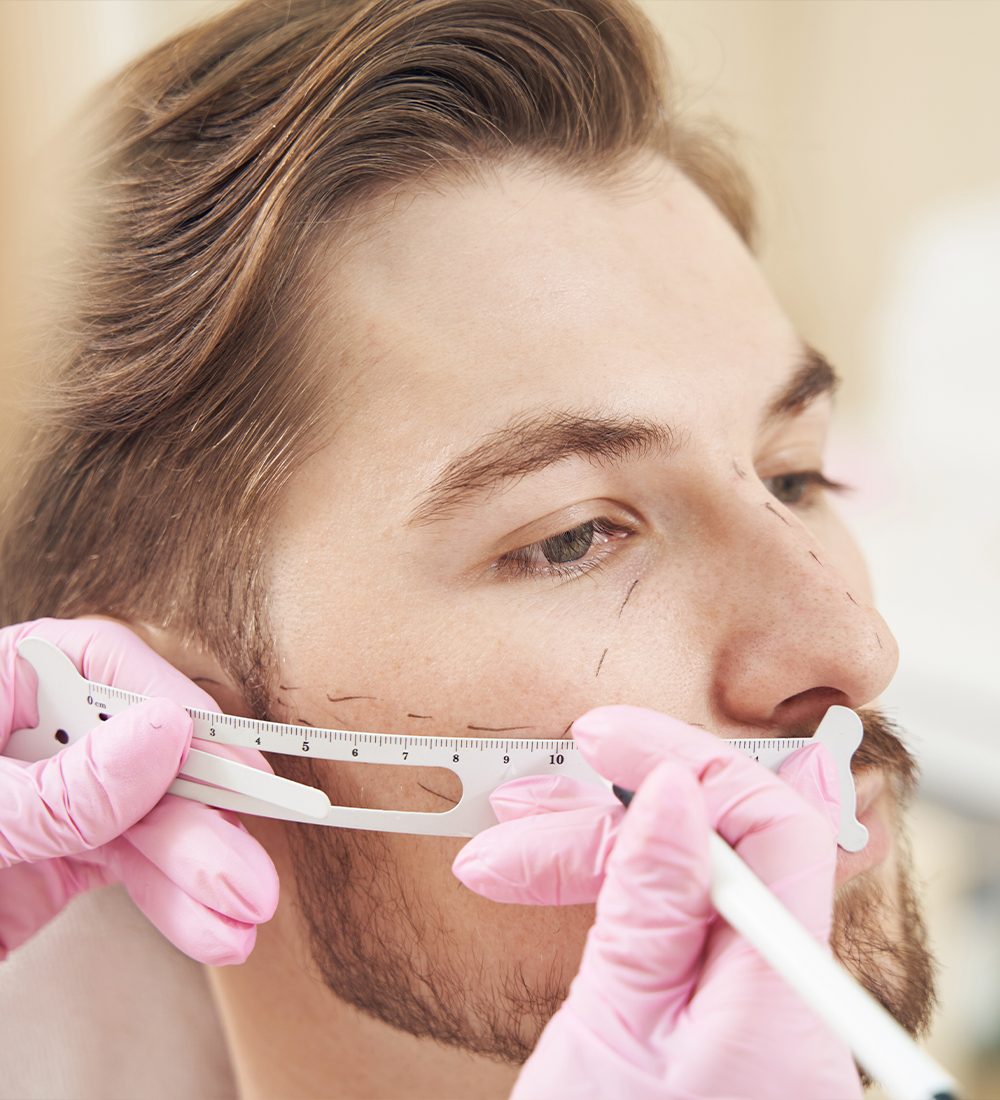 beard transplant c