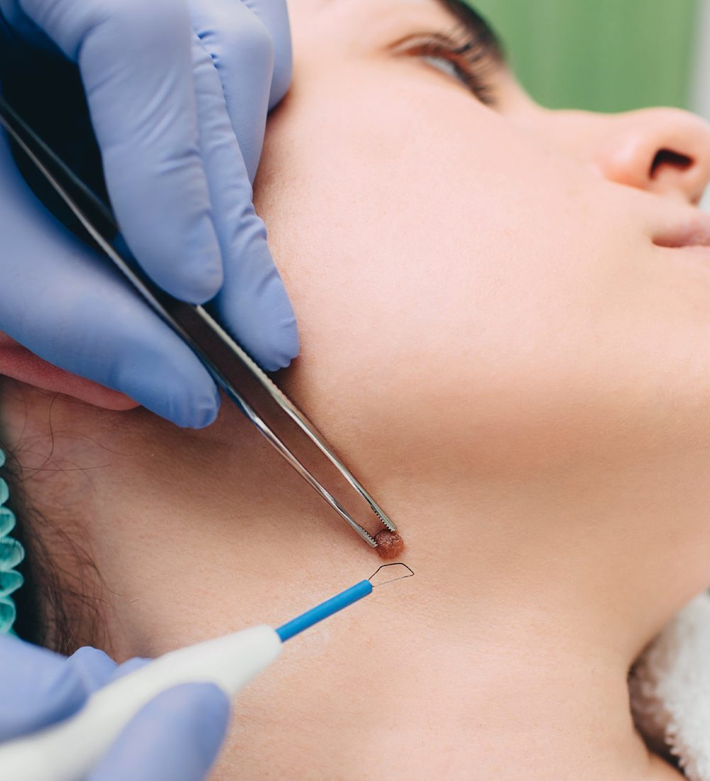 moles treatment c